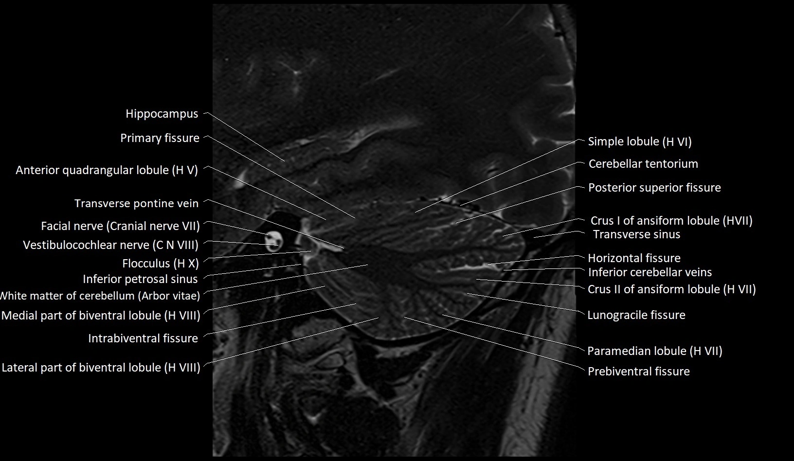 MRI Cerebellar anatomy sagittal High-resolution labelled image 14.webp